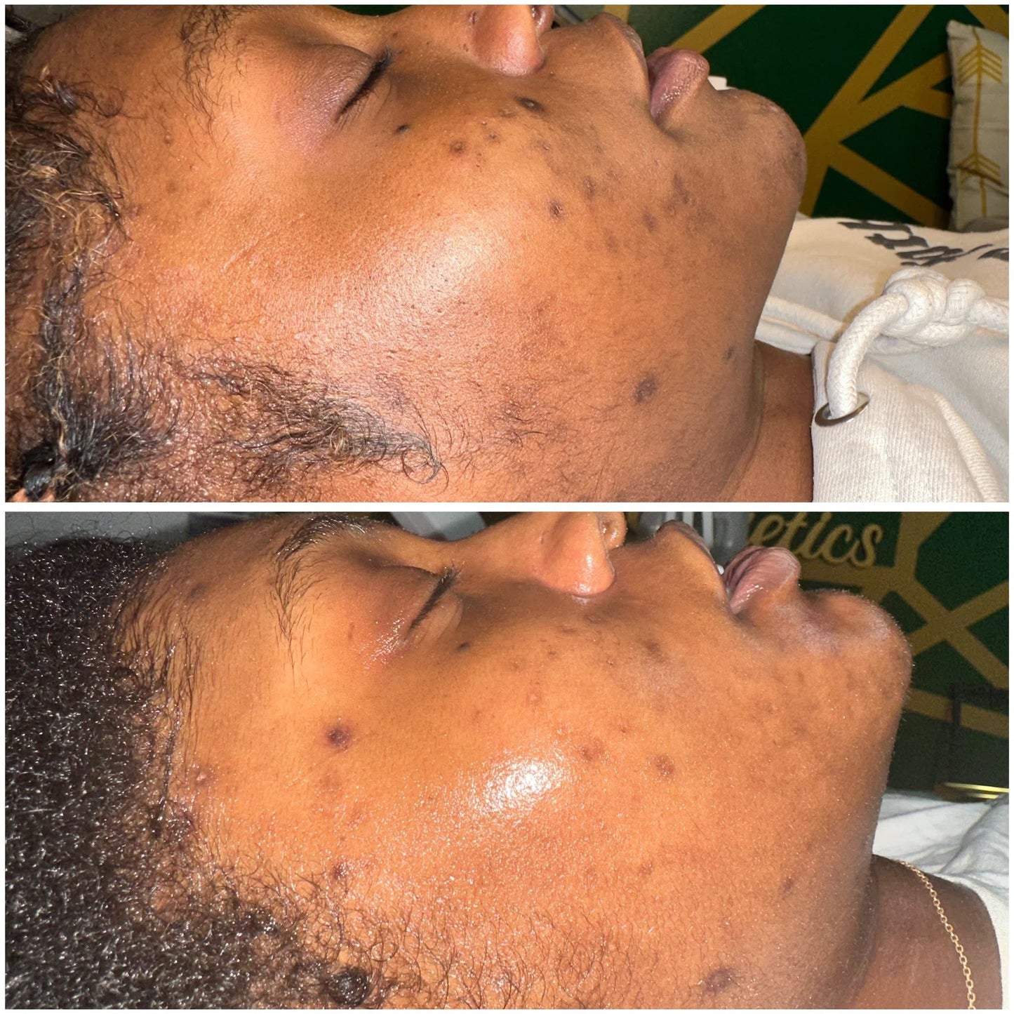 Client skin progress after corrective facial care, before and after