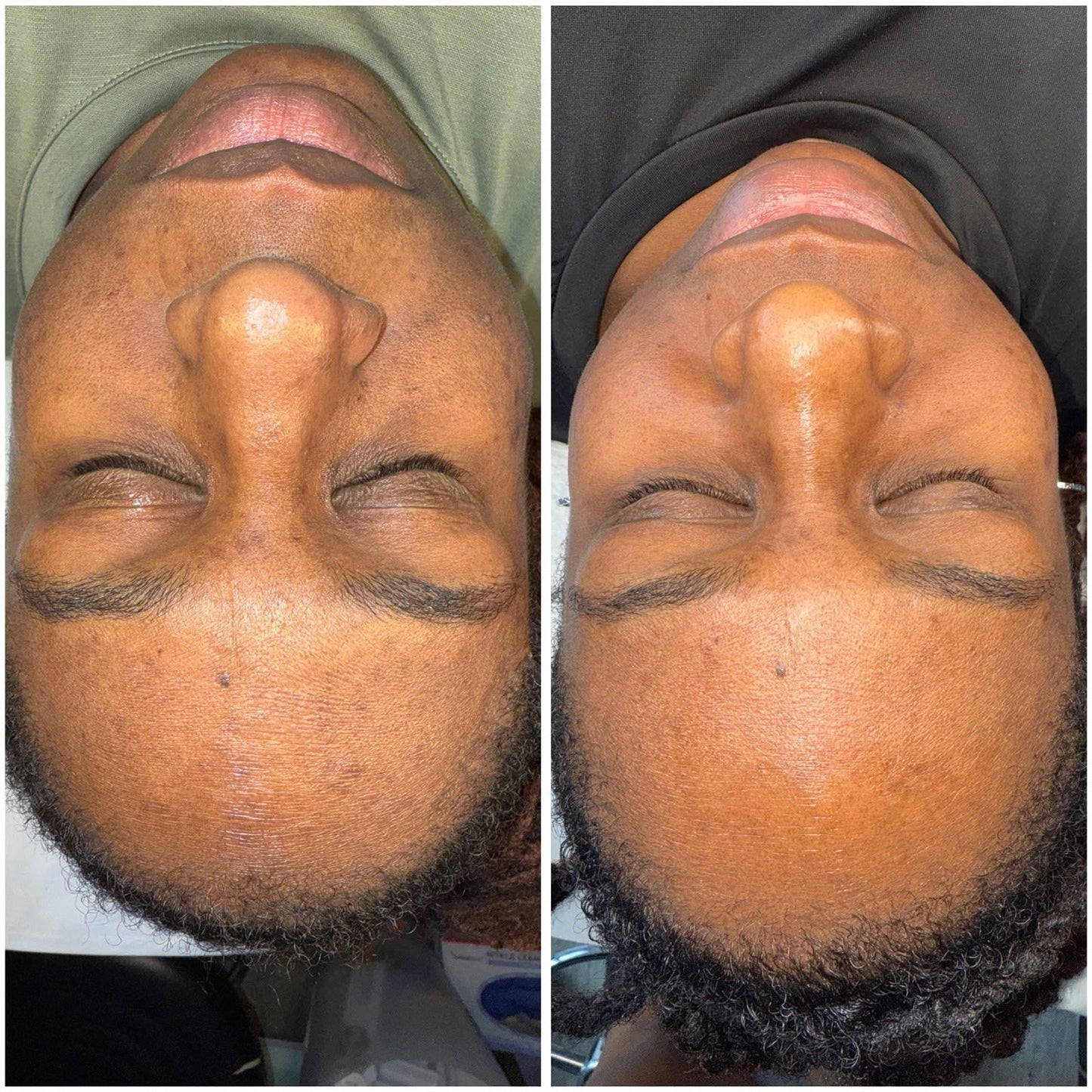 College student deep cleaning facial result, before and after