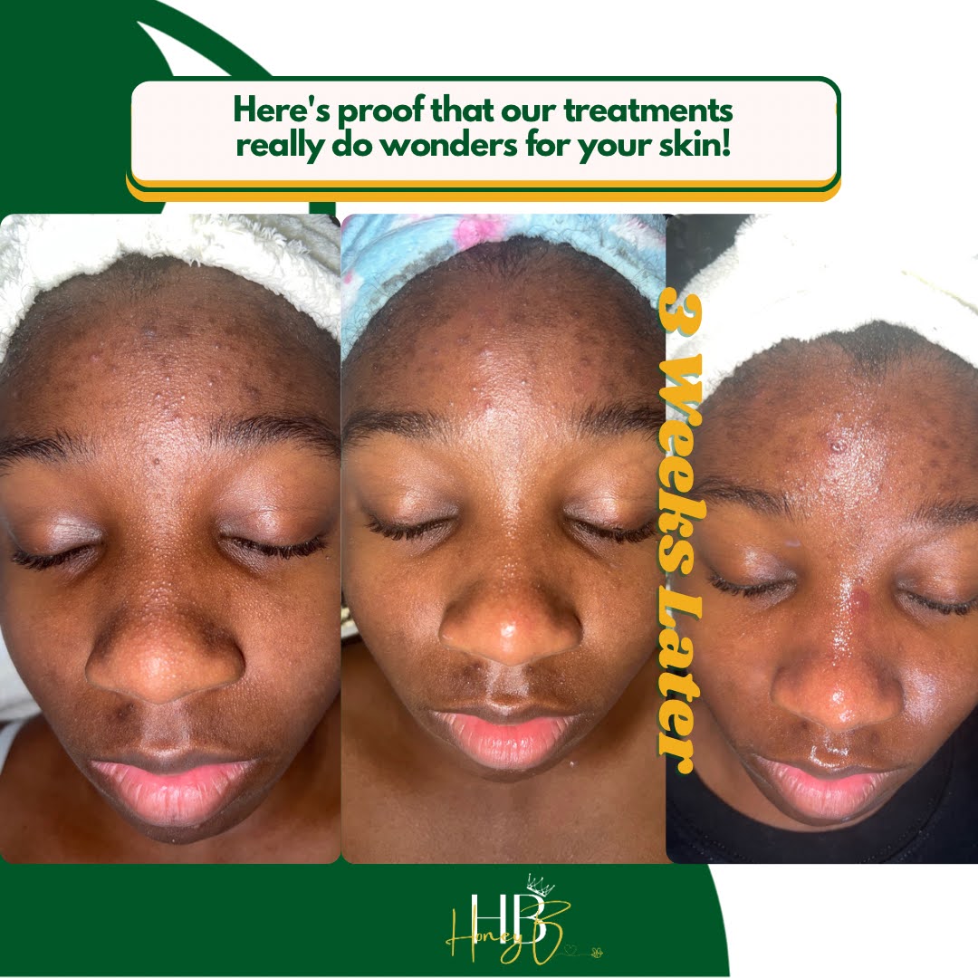 Teen Acne Relief Facial