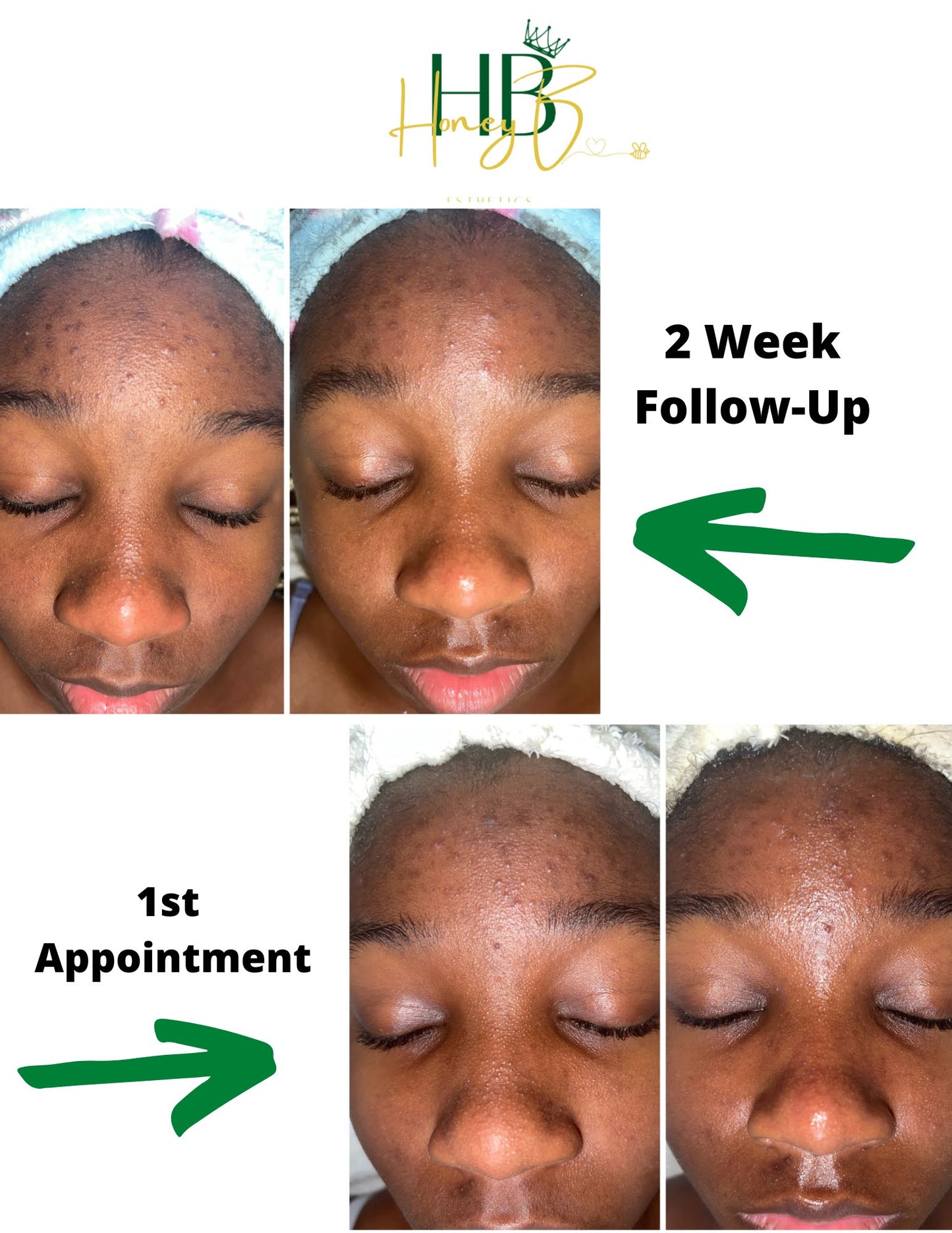 Teen Acne Relief Facial