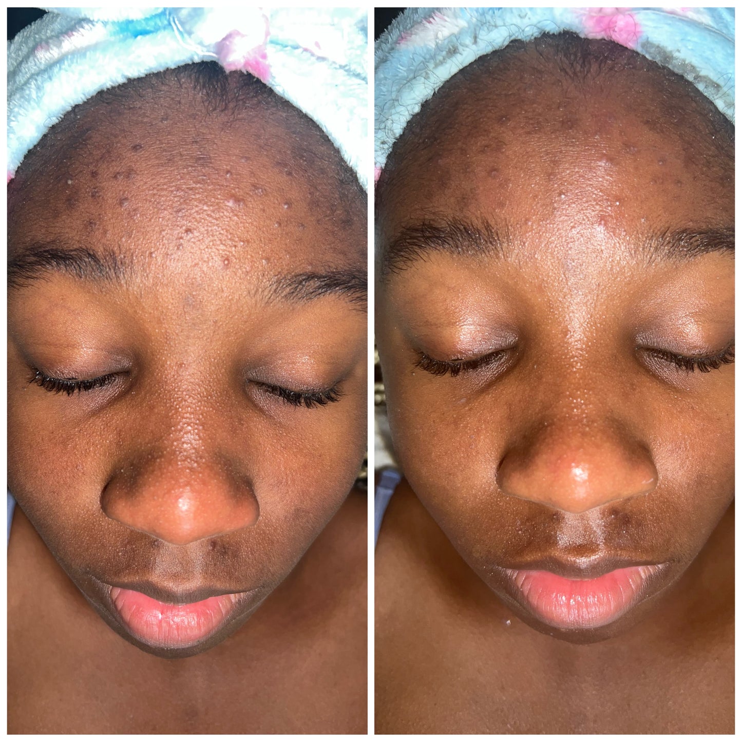 Teen Acne Relief Facial