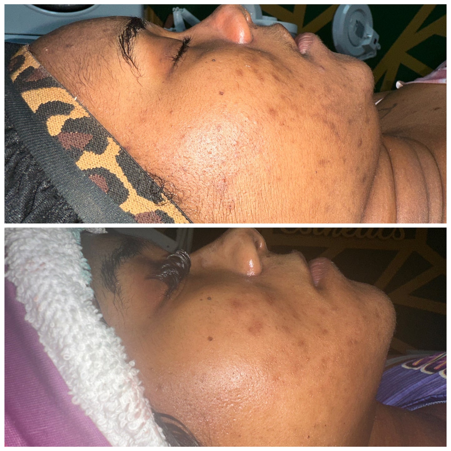 Hyperpigmentation Bootcamp