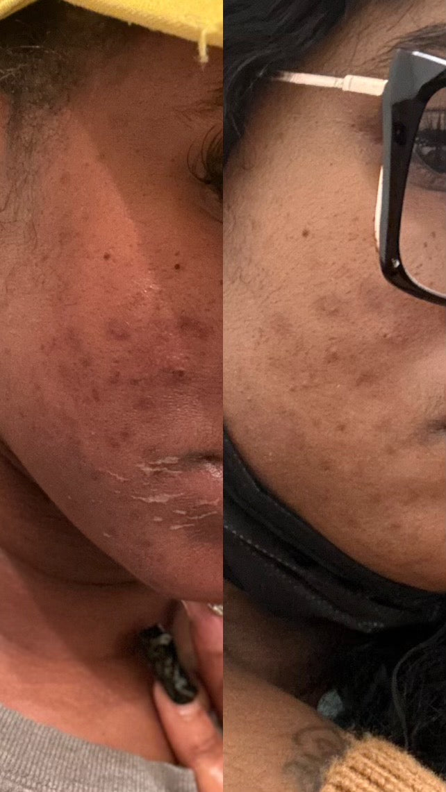 Hyperpigmentation Bootcamp