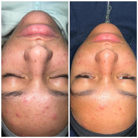 Acne Kit