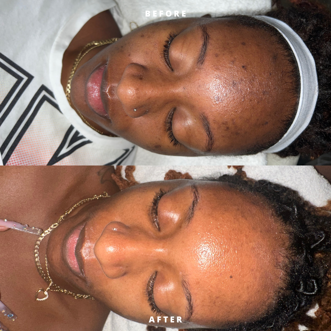 Hyperpigmentation Kit
