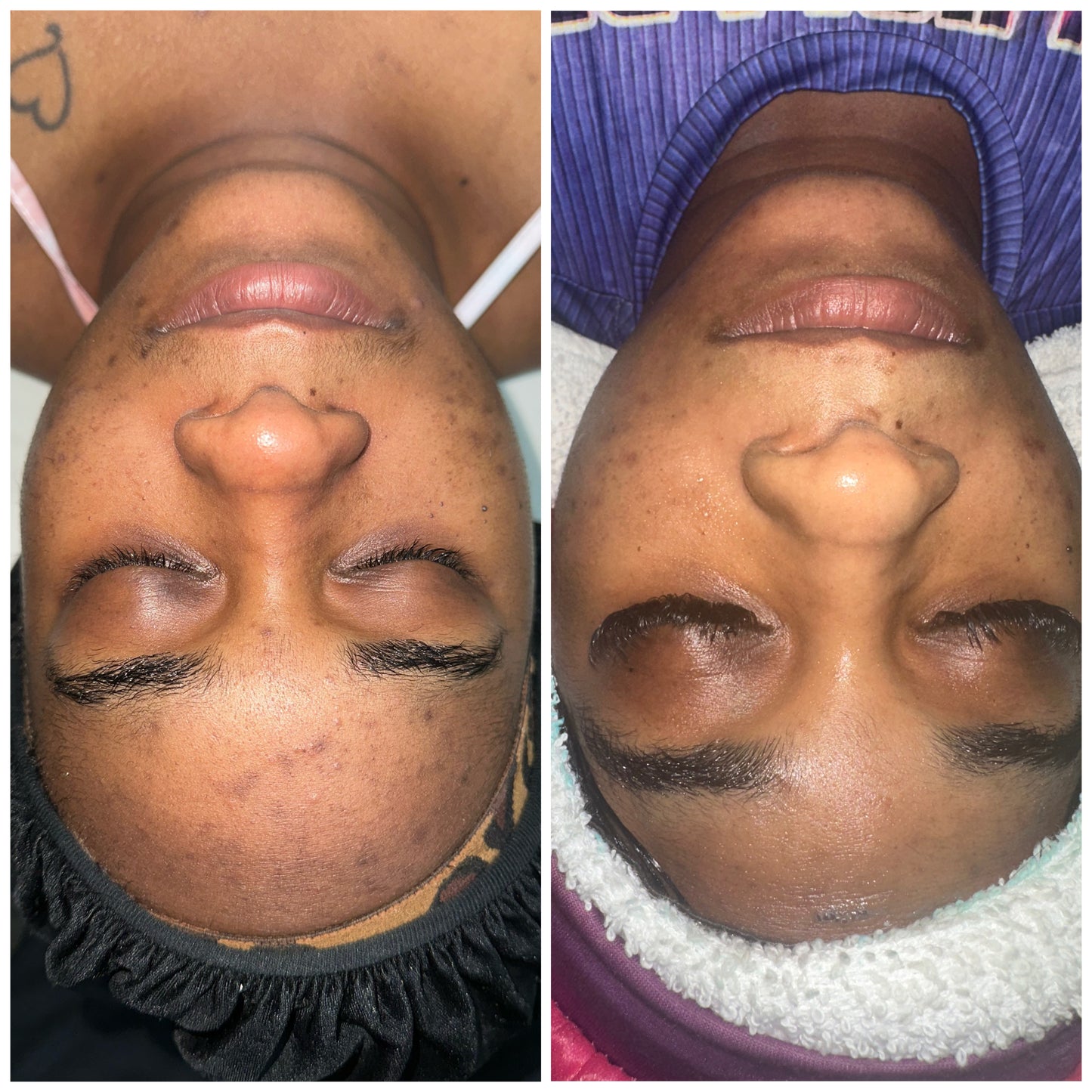 Hyperpigmentation Bootcamp