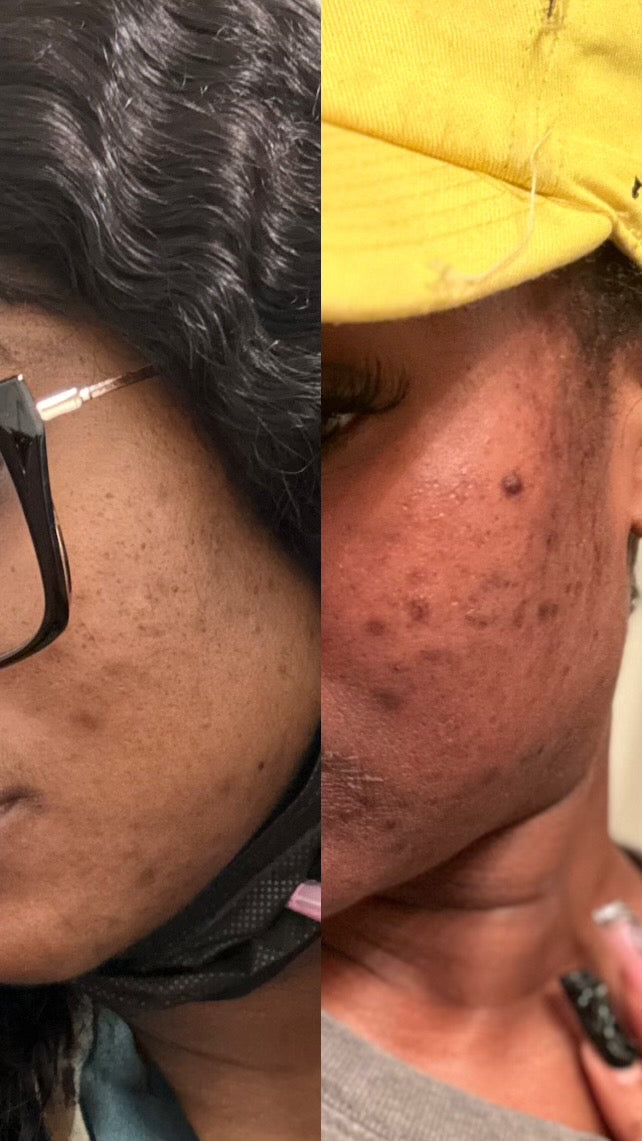 Hyperpigmentation Bootcamp