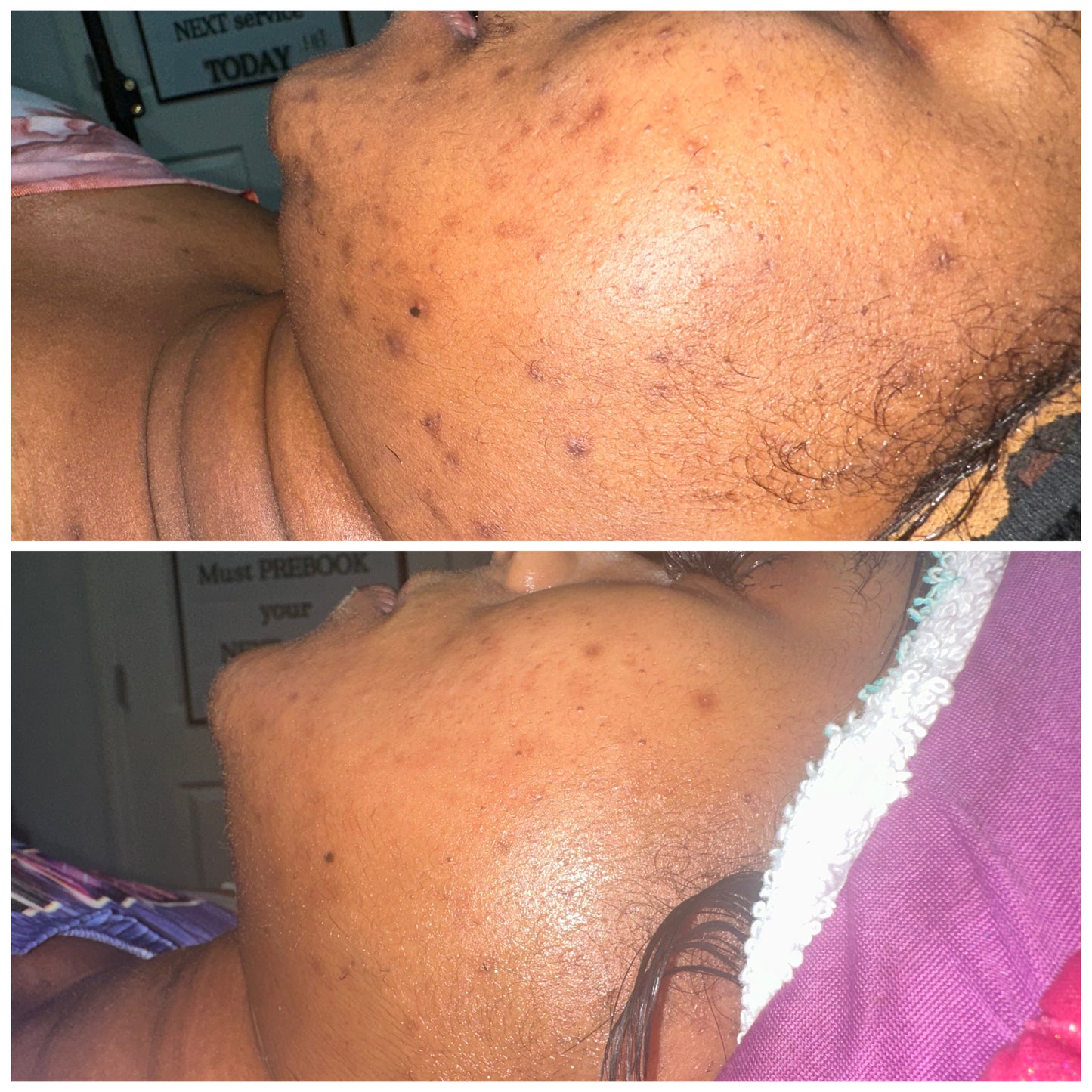 Hyperpigmentation Bootcamp