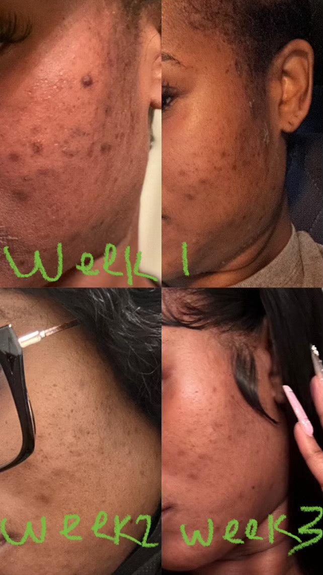 Hyperpigmentation Bootcamp