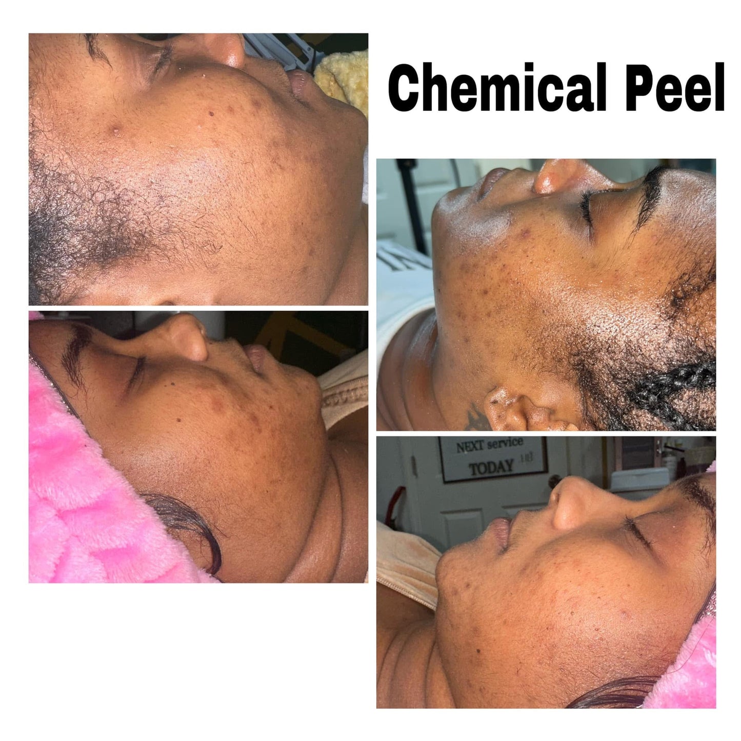 Chemical peel client results at Honey B Esthetics