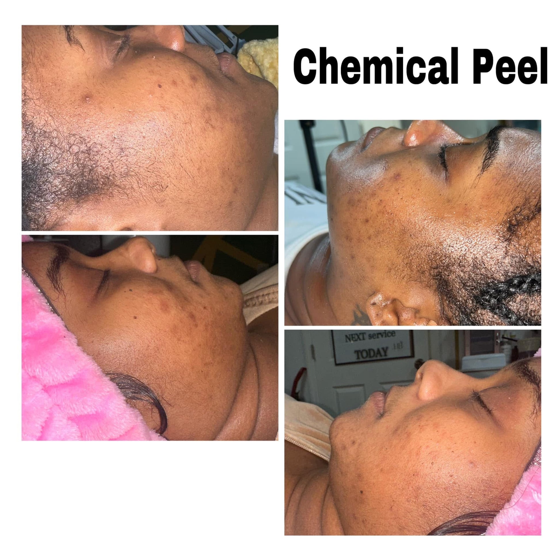Chemical peel client results at Honey B Esthetics