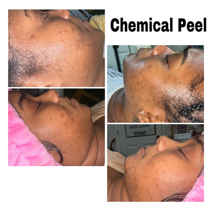 Chemical peel client results at Honey B Esthetics