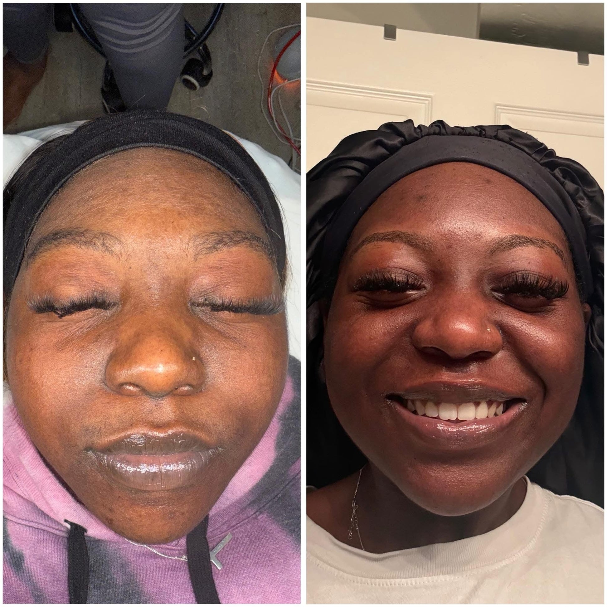 Honey B Esthetics client facial result, before and after