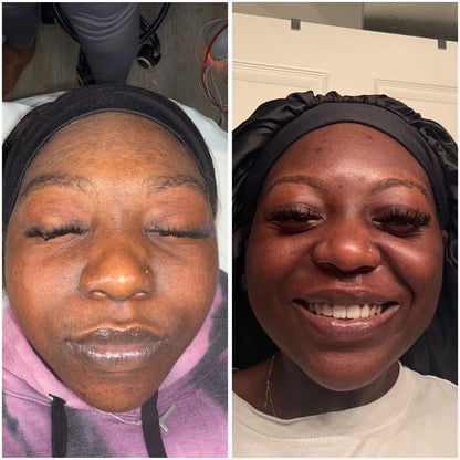 Honey B Esthetics client facial result, before and after