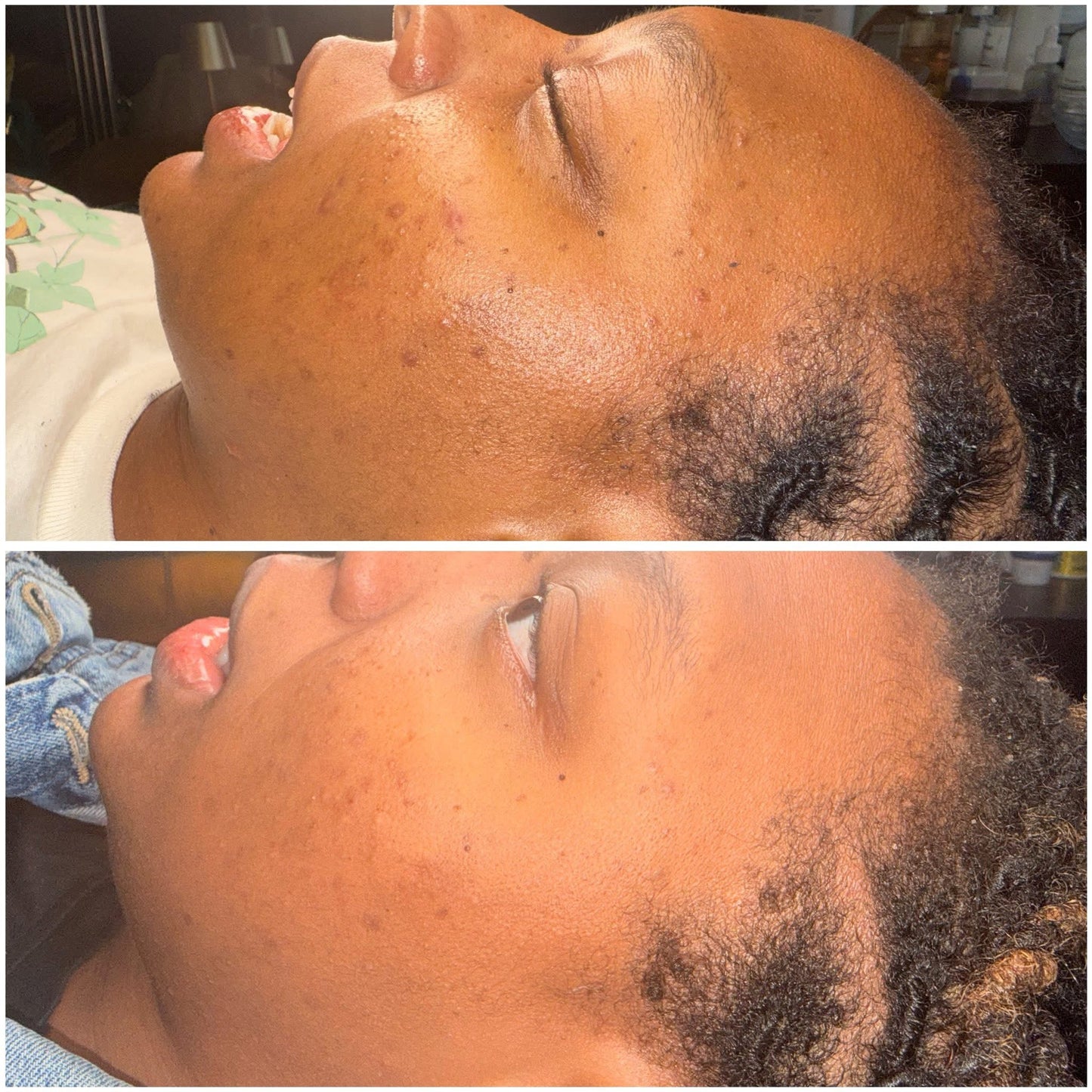 Corrective facial result for texture and dark spots, before and after