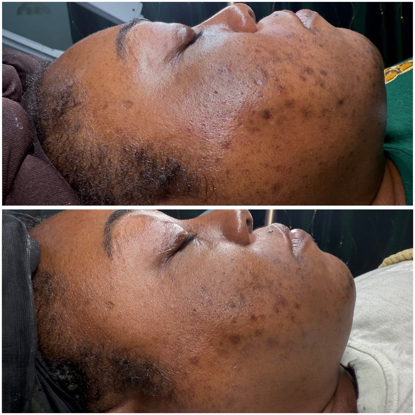 Corrective facial result for acne and hyperpigmentation, before and after