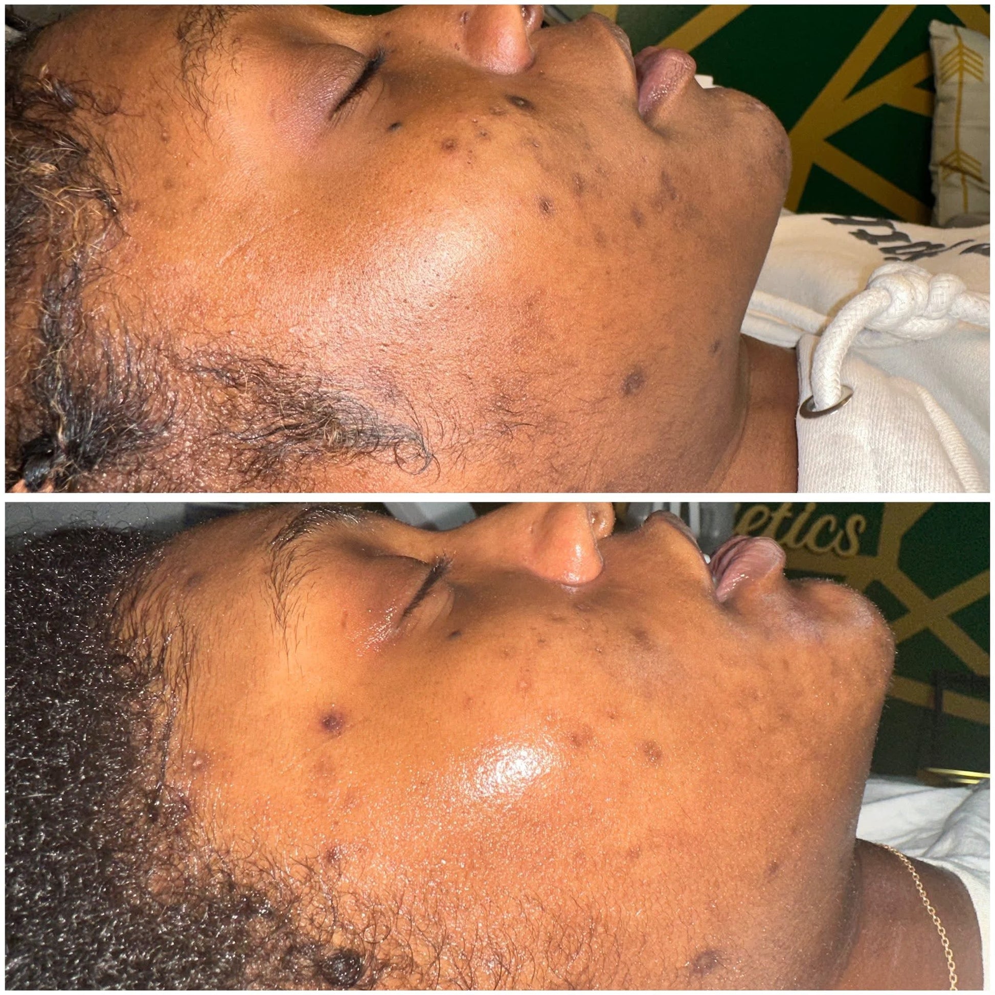 Client skin progress after corrective facial care, before and after