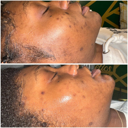 Client skin progress after corrective facial care, before and after