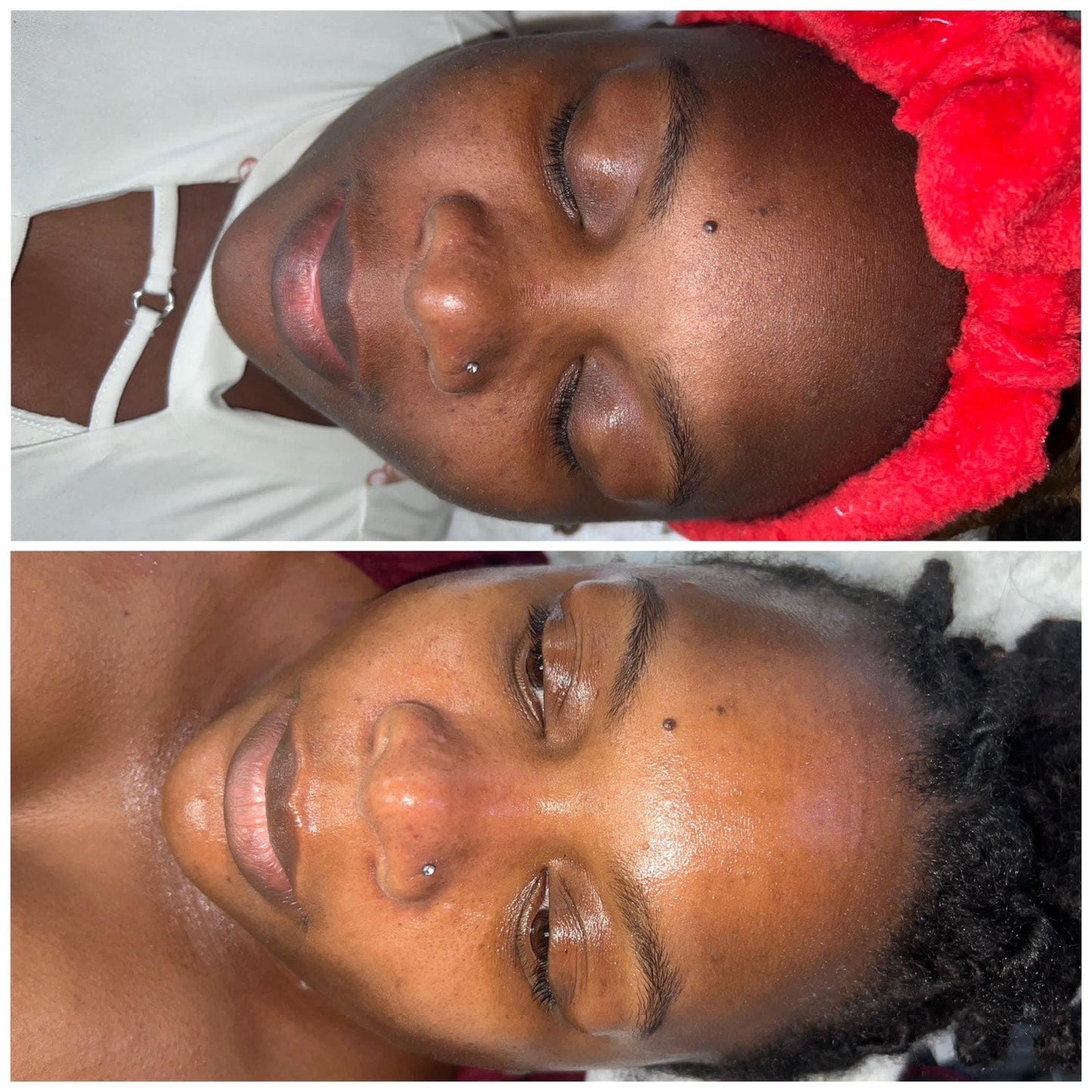 Hyperpigmentation Bootcamp