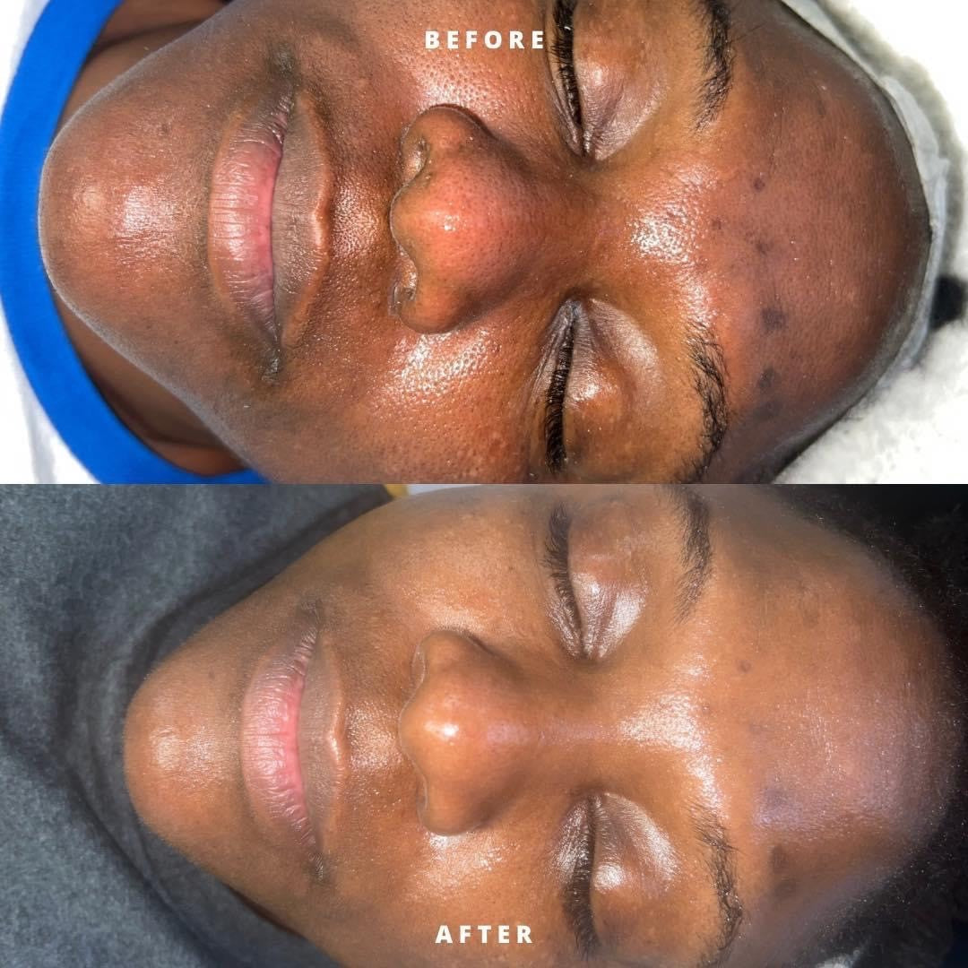 Hyperpigmentation Bootcamp