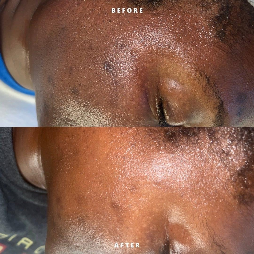 Hyperpigmentation Bootcamp