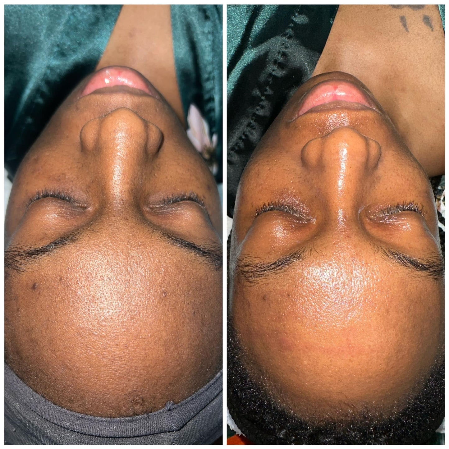 Hyperpigmentation Bootcamp