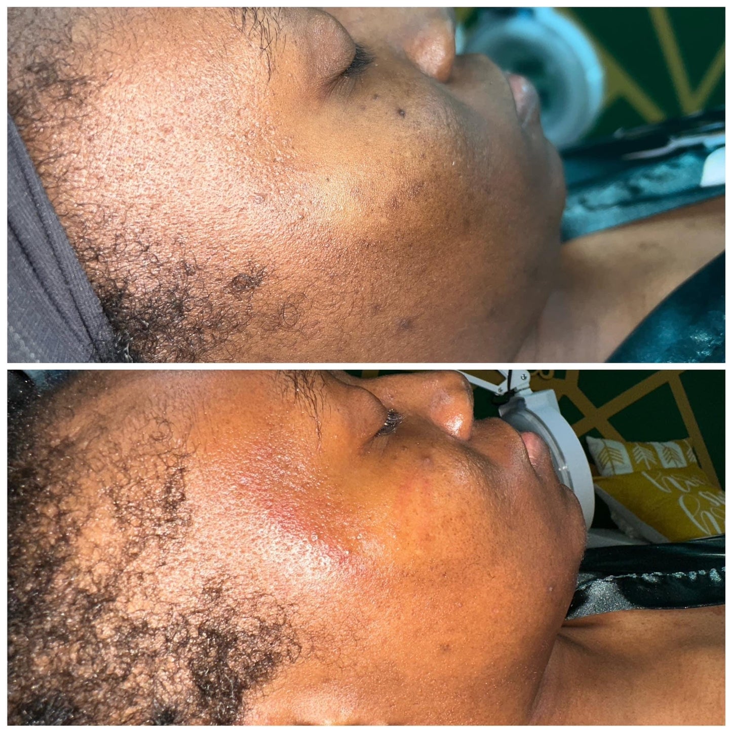 Hyperpigmentation Bootcamp