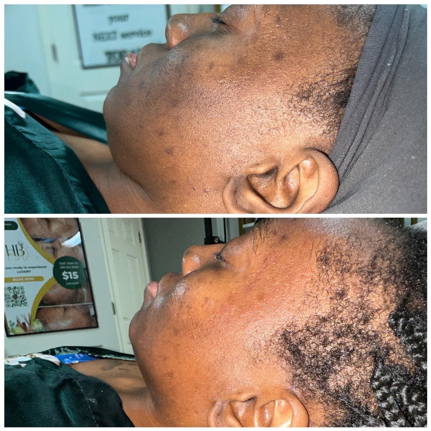 Hyperpigmentation Bootcamp