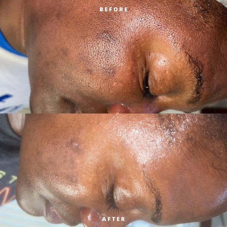 Hyperpigmentation Bootcamp