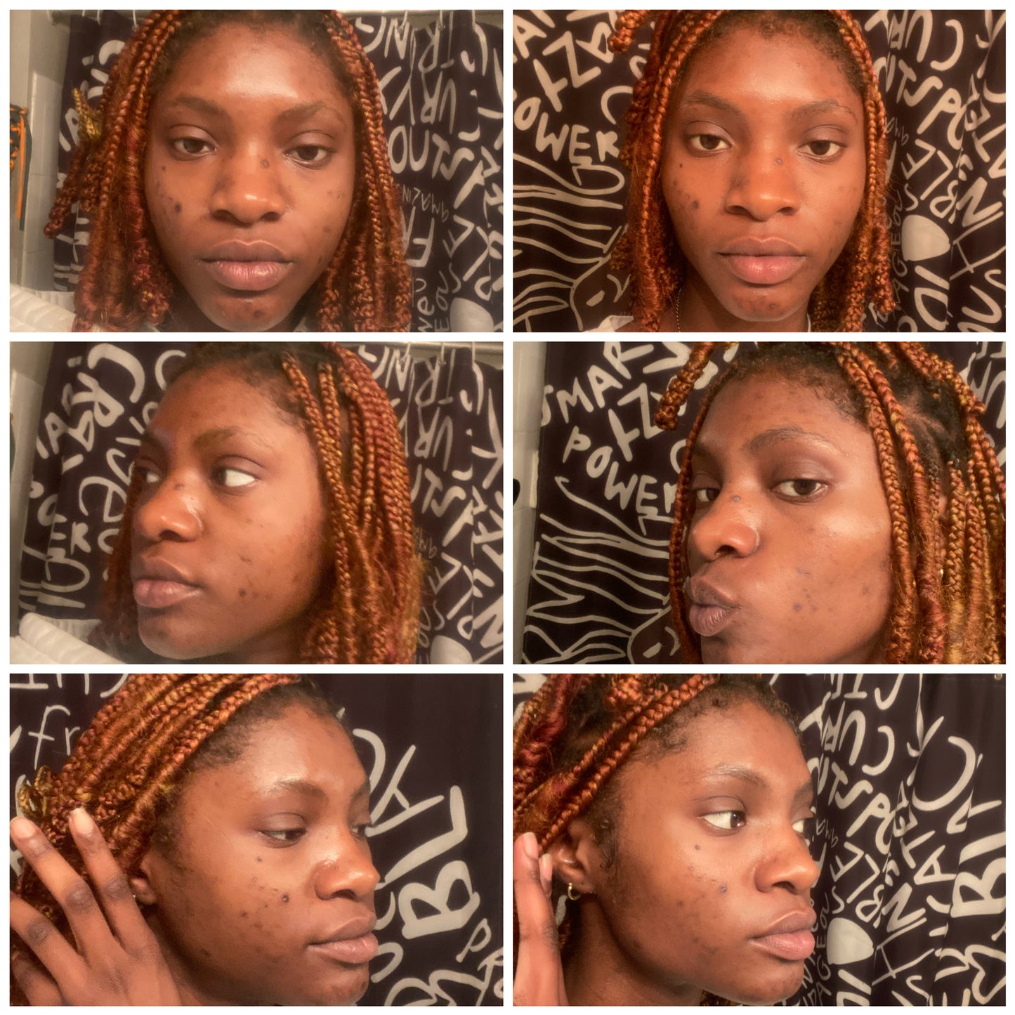 Hyperpigmentation Bootcamp