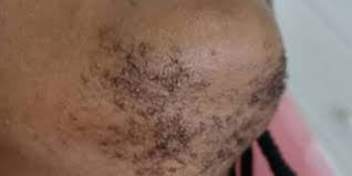 Chin Wax with Ingrown, PCOS, Hirsutism Treatment