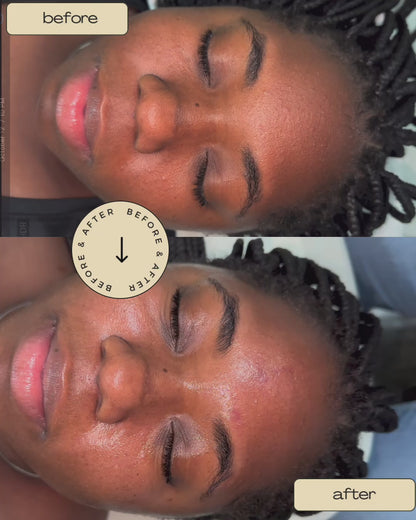 Medium Depth Chemical Peel