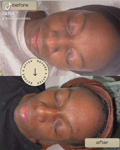 Medium Depth Chemical Peel