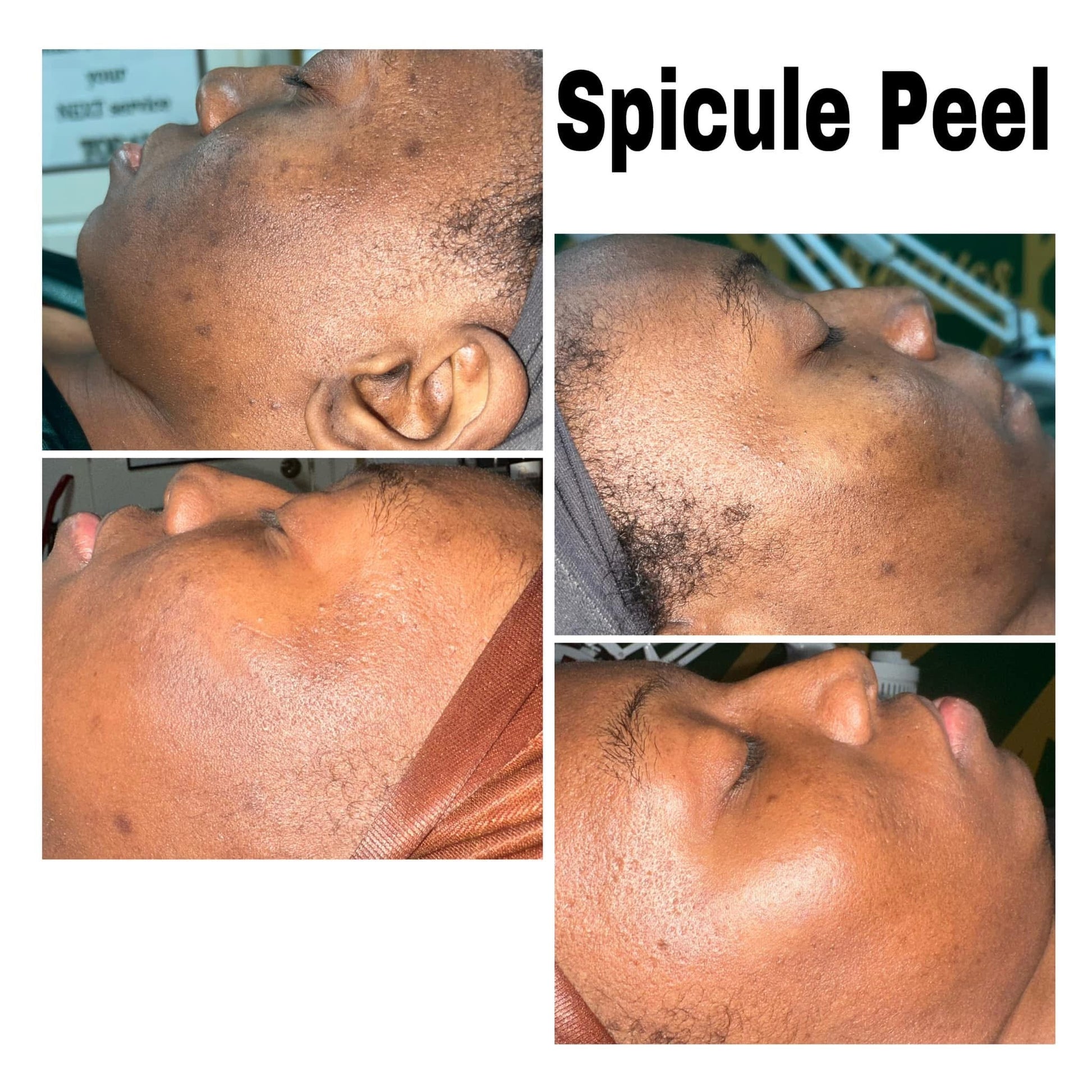 Spicule peel client results at Honey B Esthetics