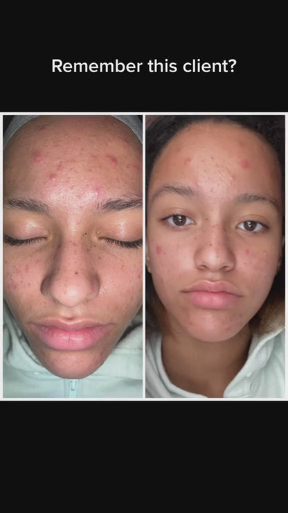 Acne Kit