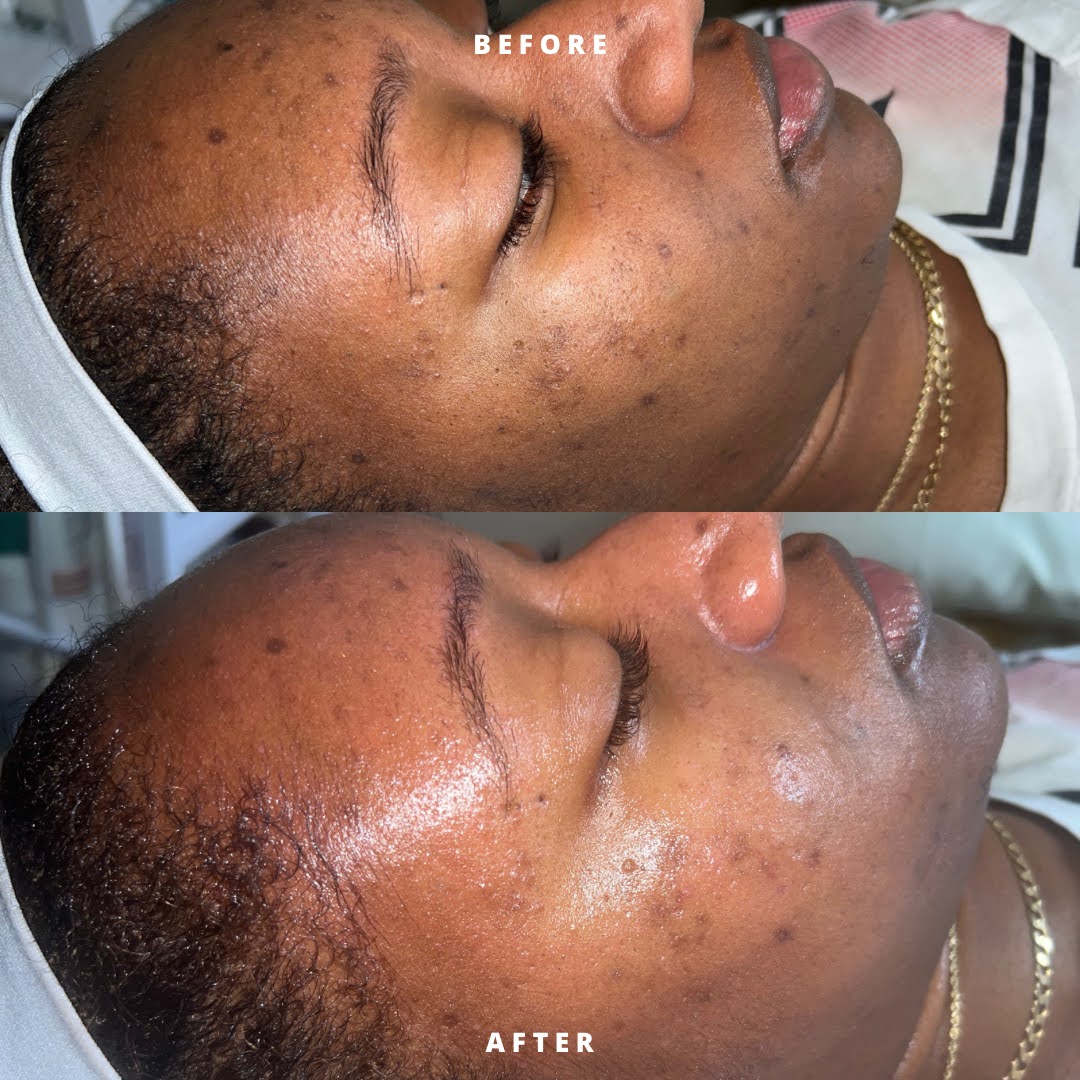 Subscription Honey Glow HydroFacial