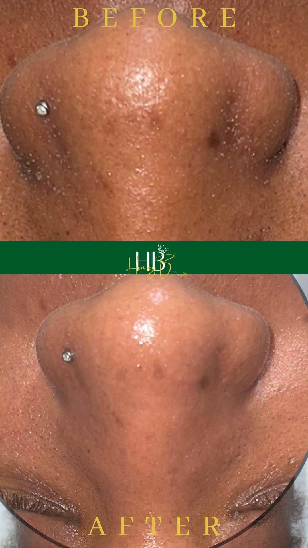 Honey Glow HydroFacial