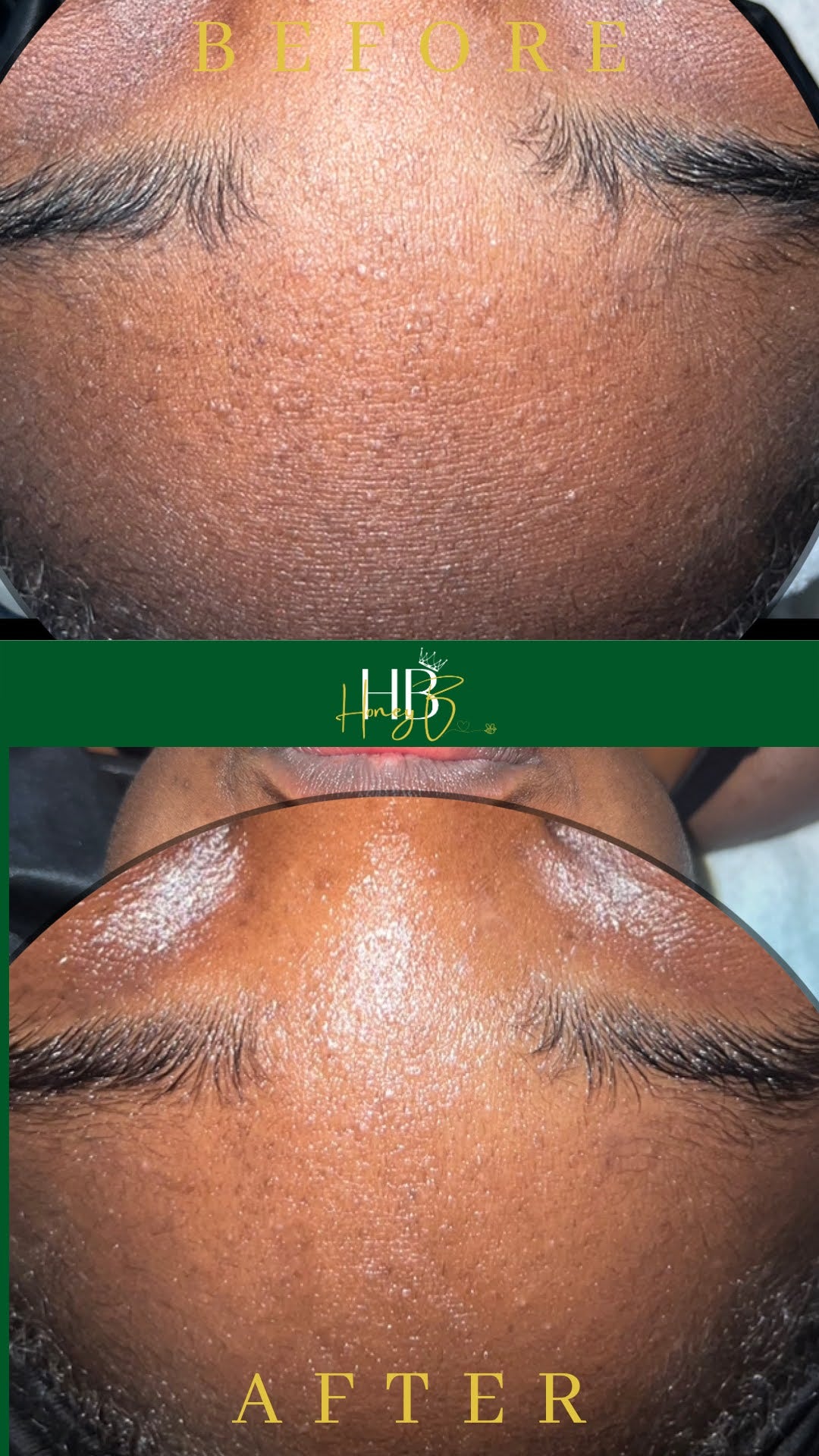 Honey Glow HydroFacial