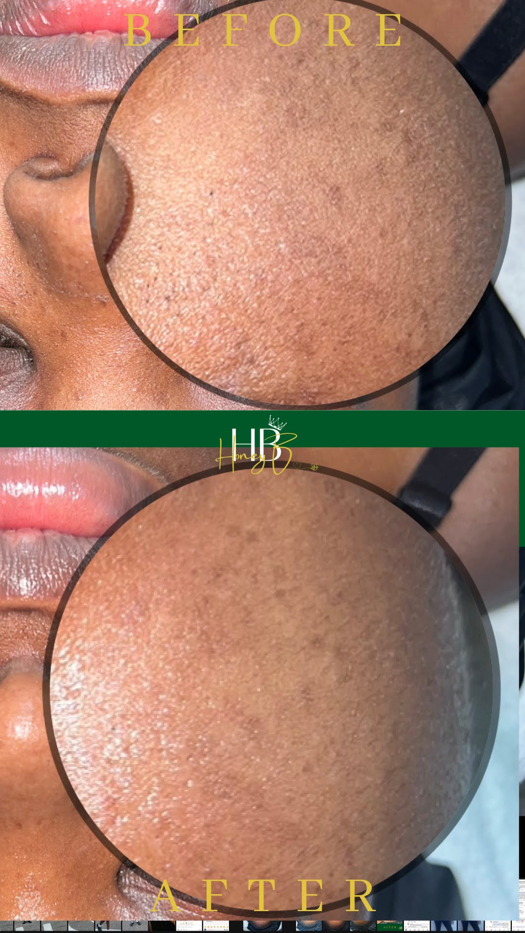 Honey Glow HydroFacial