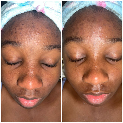 Teen Acne Relief Facial